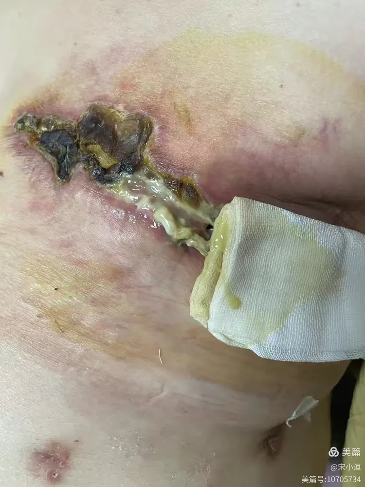 一例乳腺肿瘤术后淋巴漏伴切口感染创面的愈合过程